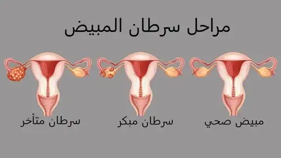 ما هي العلامات الصامتة "للسرطان القاتل"؟.. طبيبة تحذّر