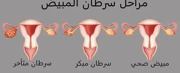 ما هي العلامات الصامتة "للسرطان القاتل"؟.. طبيبة تحذّر