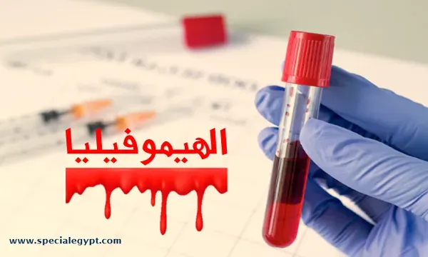 في يومه العالمي.. ماذا تعرف عن مرض الناعور أو "الهيموفيليا"؟