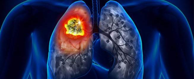 سرطان الرئة.. أكثر انتشارا في صفوف غير المدخنين!