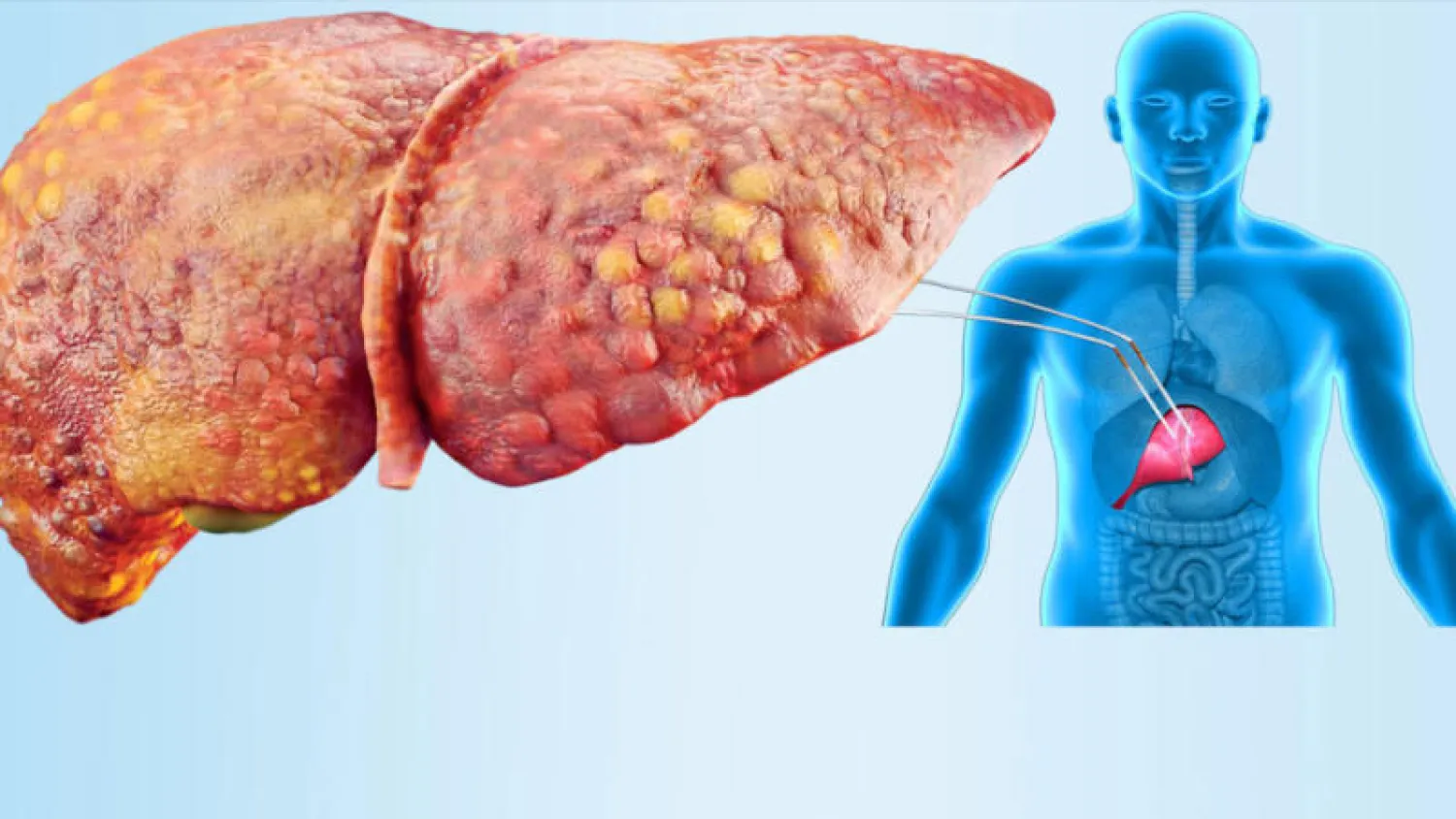 لعلاج الكبد الدهني... تناول 4 وجبات خفيفة أسبوعيًا 