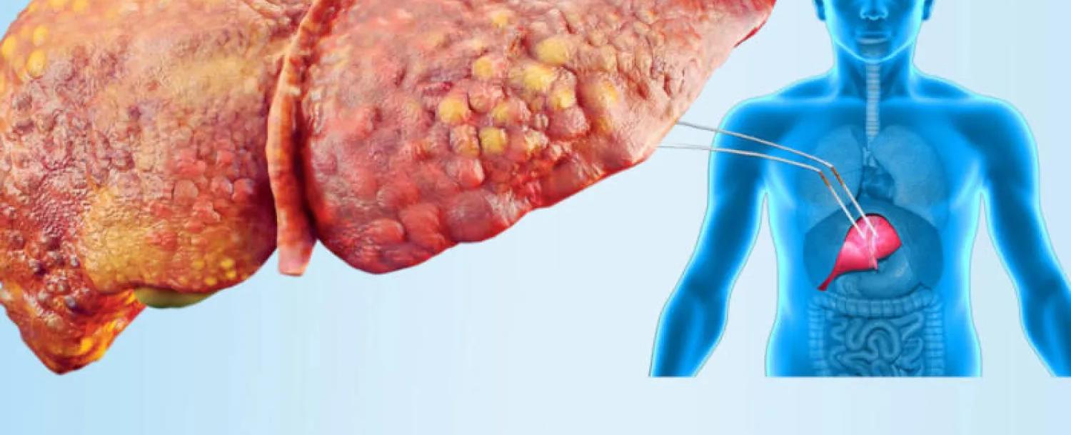 لعلاج الكبد الدهني... تناول 4 وجبات خفيفة أسبوعيًا