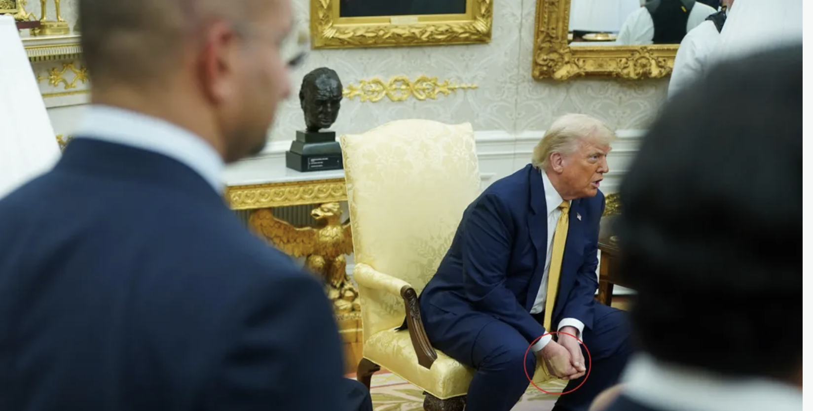 "كدمة مغطاة بالمكياج" على يد ترامب تثير تساؤلات حول صحته