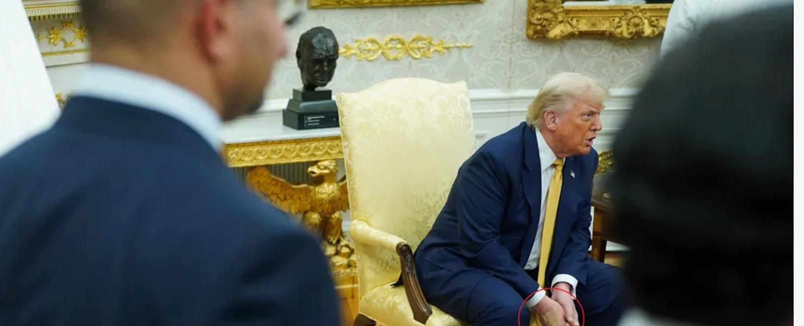 "كدمة مغطاة بالمكياج" على يد ترامب تثير تساؤلات حول صحته