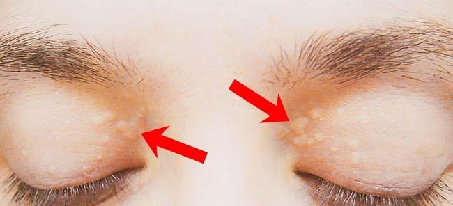 علامة تحذيرية للكوليسترول قد تكشفها عيناك... ما هي؟