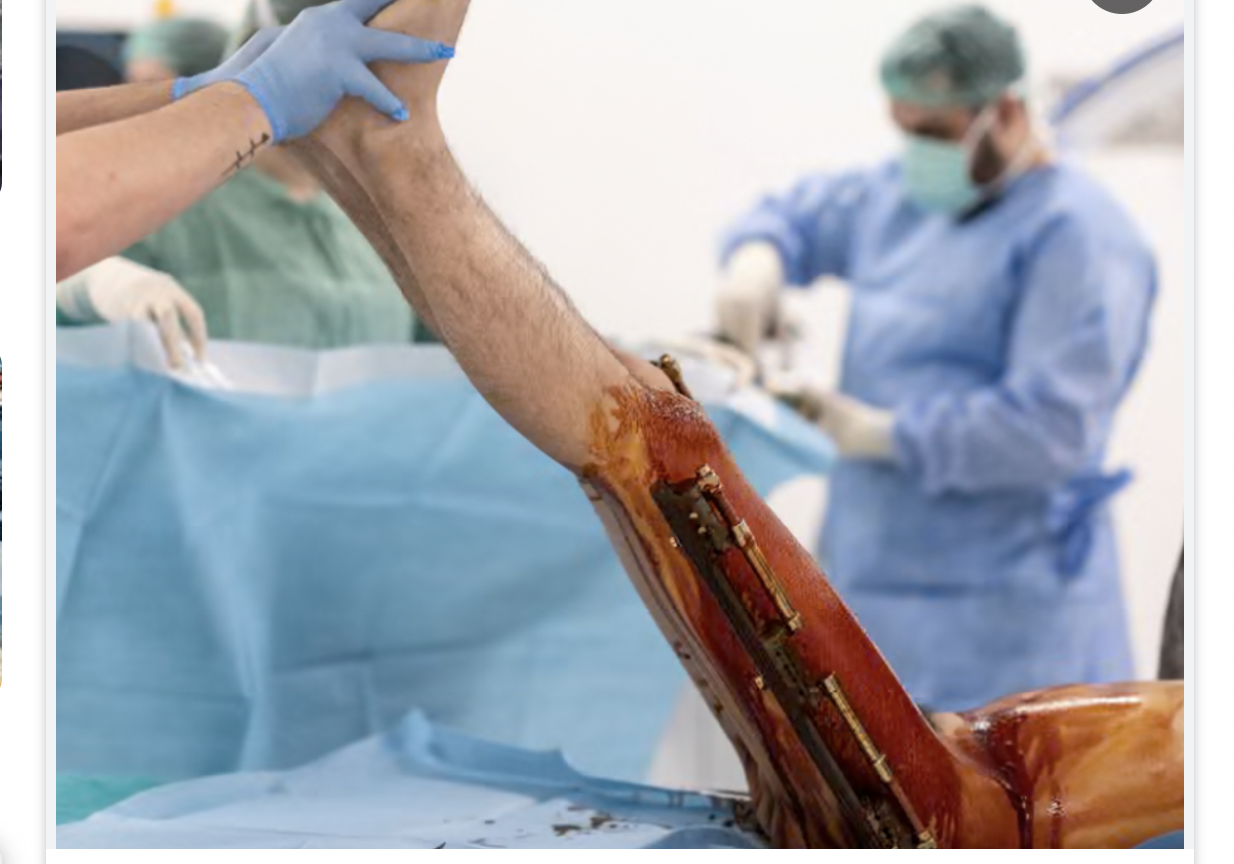 جراحة إطالة الساقين.. إقبال متزايد بين الرجال ومخاطر لا يستهان بها