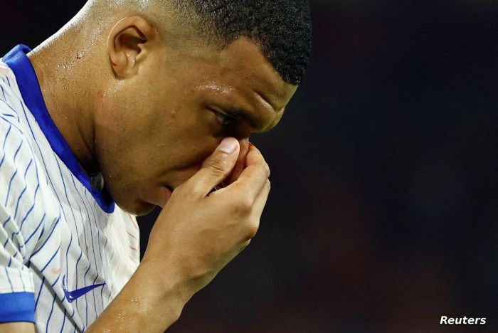 "تطورات الحالة الصحية" لمبابي بعد الكسر في أنفه