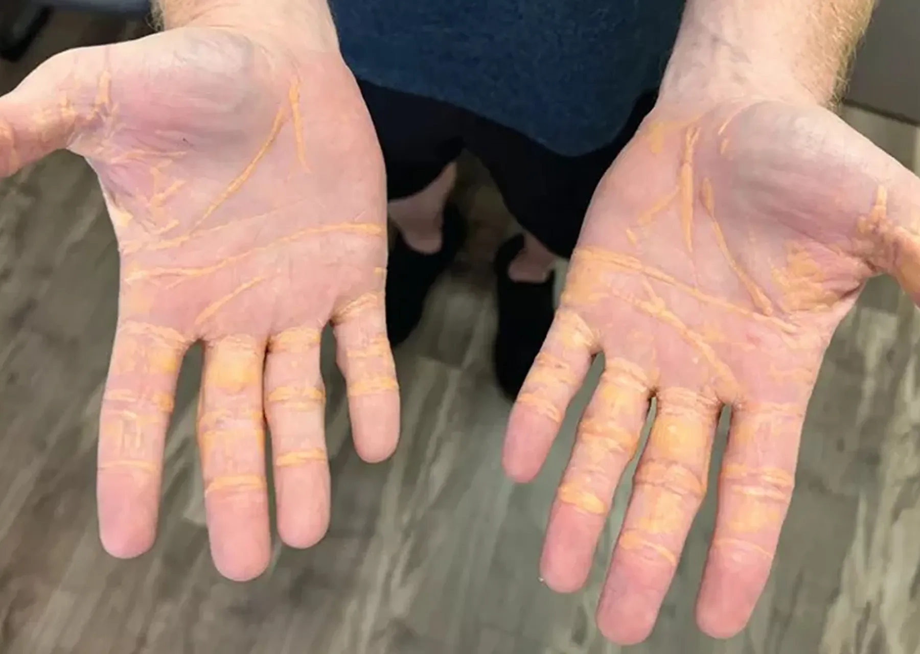 بقي أشهرًا على الأجبان الزبدة... فتسرّب الكولسترول من جلده