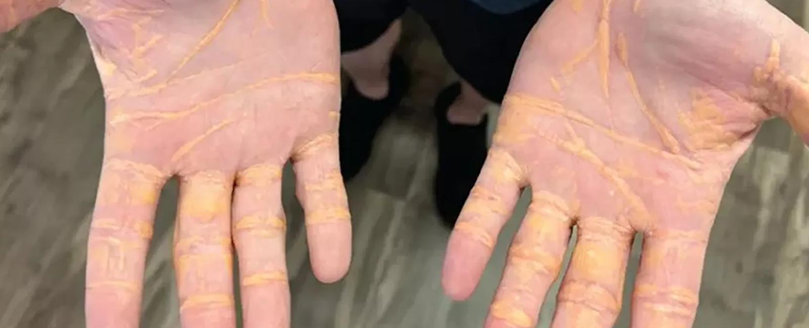 بقي أشهرًا على الأجبان الزبدة... فتسرّب الكولسترول من جلده