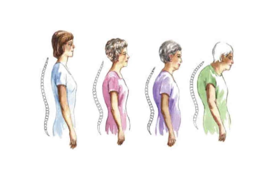 للوقاية من ترقق العظام.. تجنبي "لصوص الكالسيوم"!