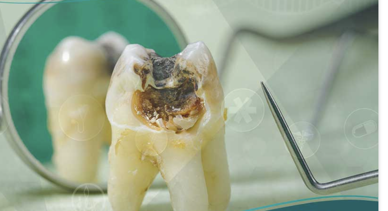 منها القبلة.. عوامل قد تتسبب في تسوّس أسنانك!