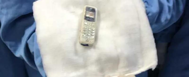 ابتلعه قبل سنوات.. استخراج هاتف من معدة سجين