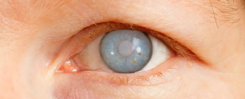 اكتشاف علمي يمهد لعلاج مبكر للمياه الزرقاء وحماية البصر