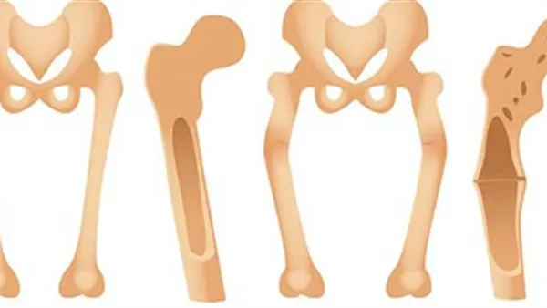 الشلل.. مرض القرن التاسع عشر يعود للظهور من جديد!