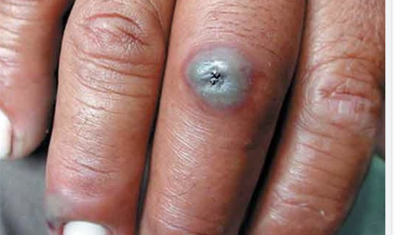 ما مرض الجمرة الخبيثة.. وإلى أي مدى هو فتّاك؟