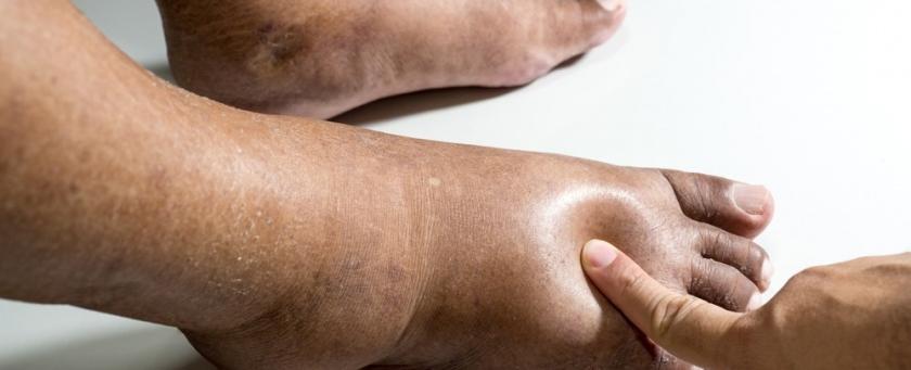 احتباس الماء: هل هناك مدرات طبيعية للبول؟