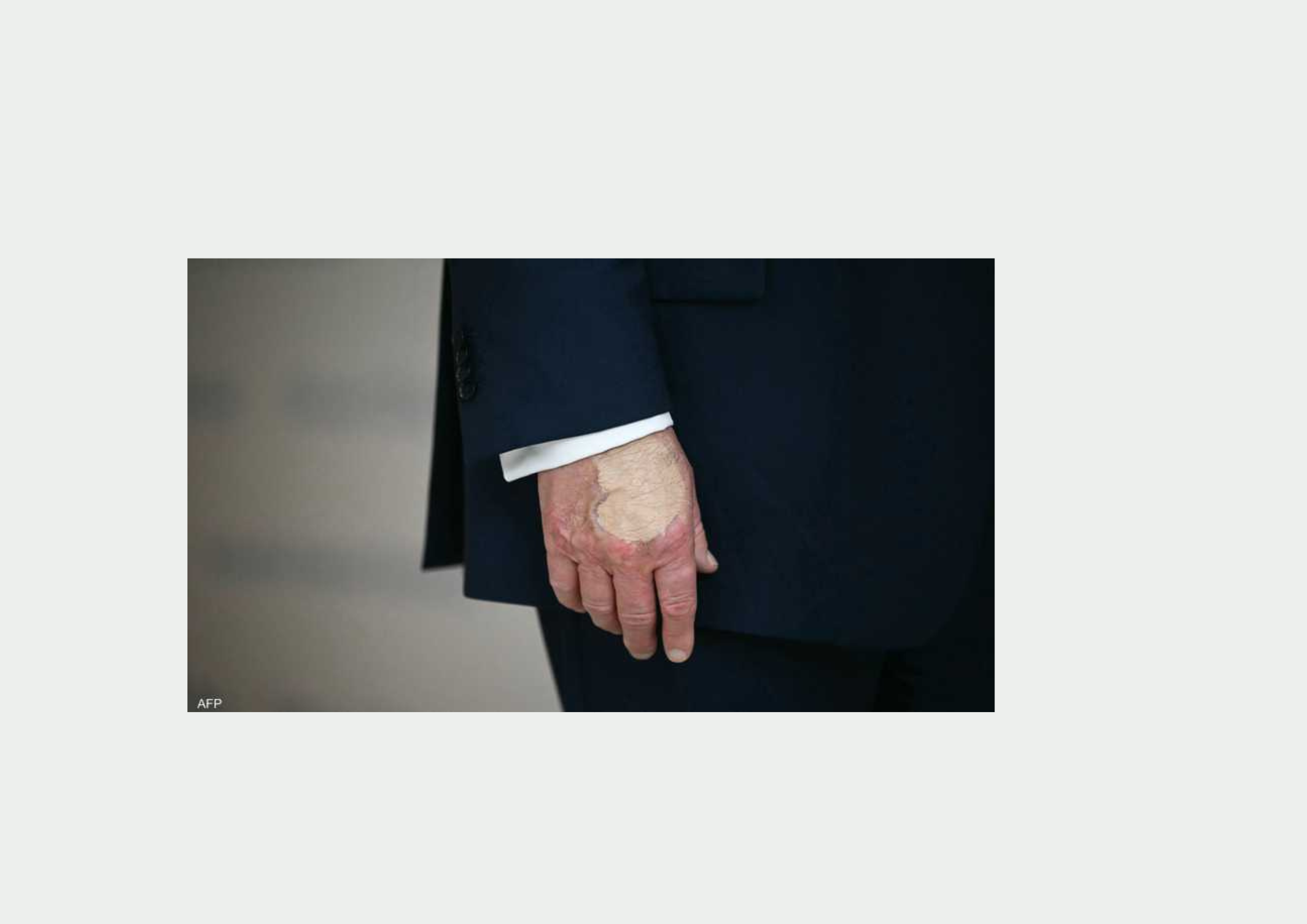 ترامب يعتمد  على جرعات أسبرين زائدة  ليتمتع ب" خفة الدم"