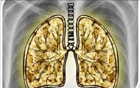   "رئة الفشار".. داء لا دواء له سببه السجائر الالكترونية