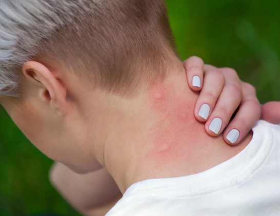 ما هو الطفح الجلدي الناتج عن التوتر؟