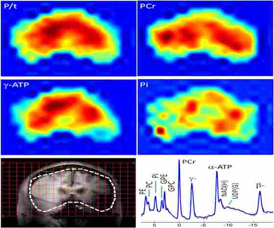 Figure 1. Whole-brain 31P MRS spectral displayed on coronal anatomical images.