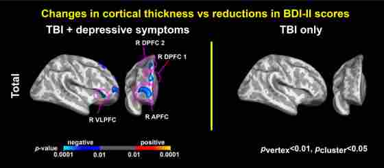 Computer imaging demonstrating two brains with clear differences in cortical thickness.