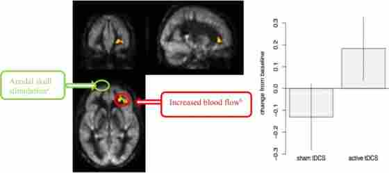 Cerebral blood flow (CBF) voxel-based analysis for the interaction contrast, superimposed on average CBF map of all participants. Right Middle Frontal Cortex (MFC) was significant at a cluster p-value = 0.05 (k = 1,168 mm3). Representation of the anodal stimulation site (green circle) and increased CBF. We illustrate the contralateral nature of the anodal stimulation from the CBF changes. (A) Anodal skull stimulation over left inferior frontal gyrus (IFG) for a total 8 sessions for 20 min prior to cognitive training over 4-week period. (B) Increased blood flow in right MFC after completing cognitive training sessions(T2-T1).