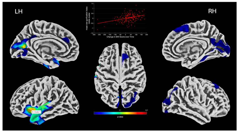 Brain surface overlay showing regions where increase in the BrainHealth Index correlated with increased structural brain health in men and women. 