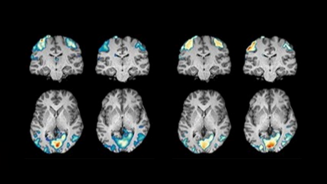 Brain imaging from Center for BrainHealth study, showing changes over time comparing pre-scan (scan 1) and post-scan (scan 2). 