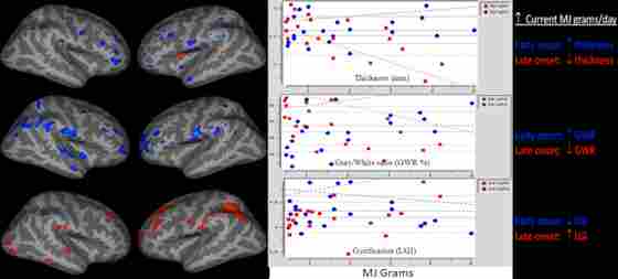 Figure 1 displays the structural differences (MRI) in the brains of marijuana users characterized by their age of onset; before age 16, or after age 16.
