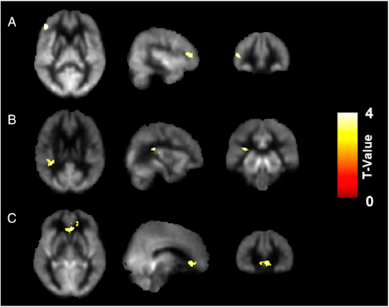 Reasoning Training in Veteran and Civilian Traumatic Brain Injury with Persistent Mild Impairment (Fig. 3)