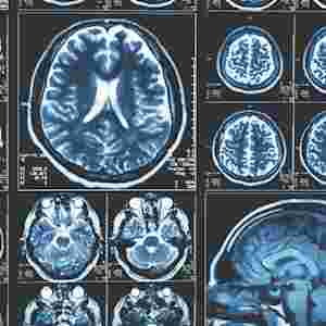 Pattern of brain scans with large and small versions