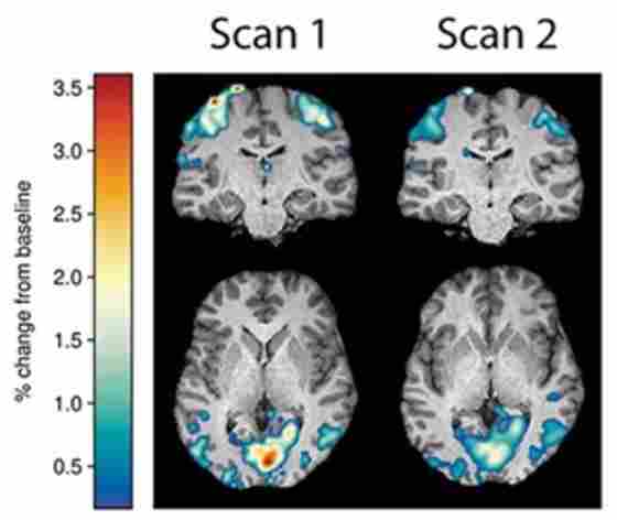 Brain scans show study participants who had normal hemodynamic response functions and showed a measurable decrease in amplitude between the baseline and second scans also demonstrated gains in their BrainHealth Index.