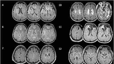 Figure 1 - Representative structural MRI images from participants with visible structural brain lesions.