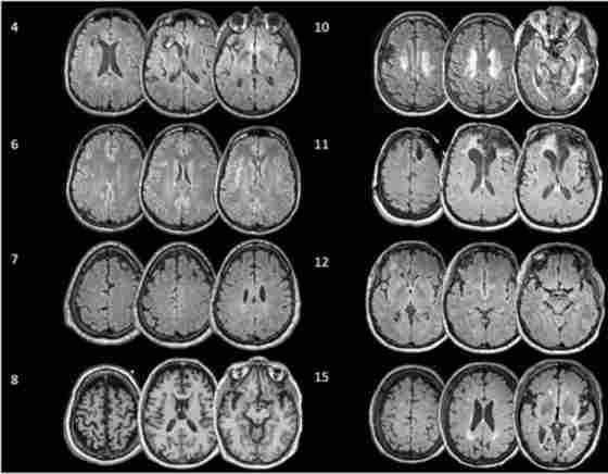 Figure 1 - Representative structural MRI images from participants with visible structural brain lesions.