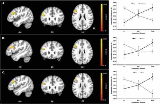 Cluster showing significant Group × Assessment Session interaction contrast of RT-related parameter estimates and mean RT-related parameter estimates as a function of assessment session and group extracted from the peak voxel within the cluster (peak voxel MNI coordinates shown below the images). Upper panel (A) shows a significant cluster in left prefrontal cortex (PFC) for the CT versus combined WLC and AC group contrasts (k=210 voxels; cluster-wise α=.05 requiring k=82 voxels at a voxel-wise Z=3.28 and α=.001); middle panel (B) shows significant cluster in left PFC for the CT versus WLC group contrast (k=139 voxels; cluster-wise α=.05 requiring k=116 voxels at a voxel-wise Z=3.28 and α=.001); and lower panel (C) shows significant cluster in left PFC for the CT versus AC group contrast (k=126 voxels; cluster cluster-wise α=.05 requiring k=126 voxels at a voxel-wise Z=3.28 and α=.001). Image orientations are in neurological convention indicated with R=Right. Red to yellow indicates increasing strength of the Group × Assessment Session interaction contrast. For assessment session, BL=baseline, Mid=6 weeks into the training or waiting period, and Post=post-training or post-waiting period. Black=Cognitive Training (CT) group, gray=combined Wait Listed Control (WLC) and Active Control (AC) group in A, gray=WLC group in B, and gray=AC group in C. Errors bars show SEM.