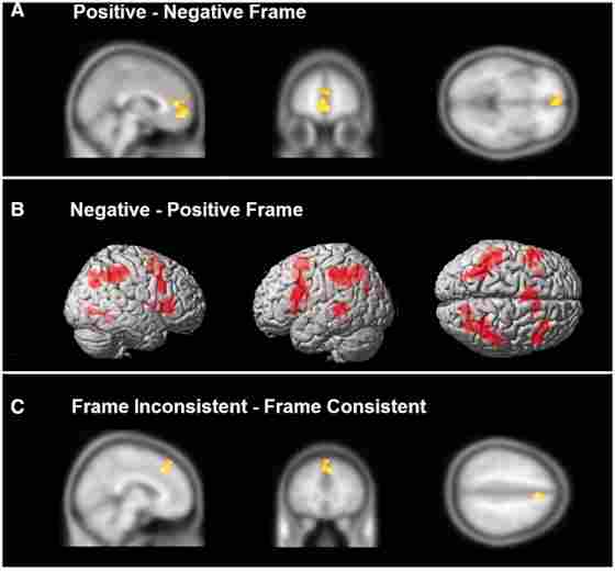 (A) Shown at the overall group level are regions involved in evaluating positively framed items over negatively framed items. This contrast resulted in a majority of regions that have been associated with reflexive processing. (B) The reverse contrast of negatively framed minus positively framed items elicited greater activation within reflective processing regions in lateral prefrontal and parietal cortex among other areas. (C) Region of the ACC associated with frame inconsistent responses and reflective processing.