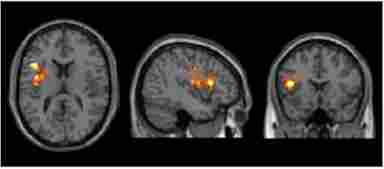 Results of cerebral blood flow (CBF) voxel based comparison superimposed on T1 image. Bipolar disorder (BD) participants showed a CBF increase in left inferior frontal gyrus from T1 to T2 after cognitive training, p < 0.05 (FWE cluster corrected) and k ≥ 11,592 mm3.