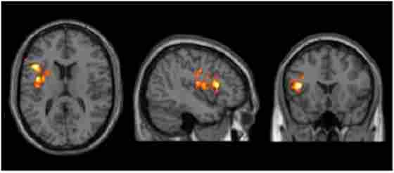 Results of cerebral blood flow (CBF) voxel based comparison superimposed on T1 image. Bipolar disorder (BD) participants showed a CBF increase in left inferior frontal gyrus from T1 to T2 after cognitive training, p < 0.05 (FWE cluster corrected) and k ≥ 11,592 mm3.