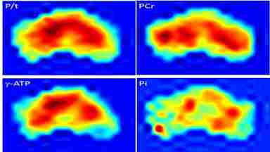 Figure 1. Whole-brain 31P MRS spectral displayed on coronal anatomical images.