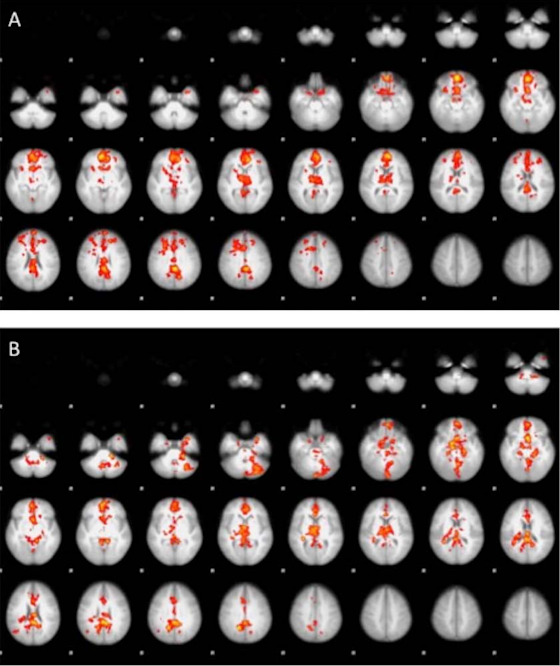 fMRI demonstrated the reward network activation of cannabis cues relative to the natural reward (A) and neutral reward (B) in users compared to non-users.