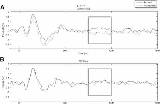 Figure 1. Group evoke-related potential (ERP) amplitudes (μV) at electrode F7 during the Semantic Object Retrieval Test task. Data for the retrieval condition are shown in black; data for the non-retrieval condition are shown by a dashed line. There was a significant difference (750–1000 msec) between conditions for the control group (A) but not the traumatic brain injury (TBI) group (B).