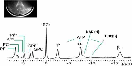 Figure 1. Spectral display of high-energy phosphate and membrane phospholipid phosphorus metabolites from the parieto-occipital lobe of amnestic mild cognitive impairment individual. PE, phosphoethanolamine; PC, phosphocholine; Piex and Piin inorganic phosphate external and internal, respectively; GPE, glycerophosphoethanolamine; GPC, glycerophosphocholine; PCr, phosphocreatine; ATP forms: α, β, and δ adenosine triphosphate; NAD, nicotinamide adenine dinucleotide; UDPG, uridine diphosphate glucose.