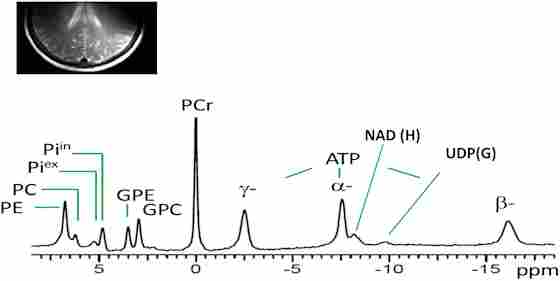 Figure 1. Spectral display of high-energy phosphate and membrane phospholipid phosphorus metabolites from the parieto-occipital lobe of amnestic mild cognitive impairment individual. PE, phosphoethanolamine; PC, phosphocholine; Piex and Piin inorganic phosphate external and internal, respectively; GPE, glycerophosphoethanolamine; GPC, glycerophosphocholine; PCr, phosphocreatine; ATP forms: α, β, and δ adenosine triphosphate; NAD, nicotinamide adenine dinucleotide; UDPG, uridine diphosphate glucose.