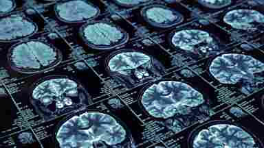 A group of MRI brain scans.