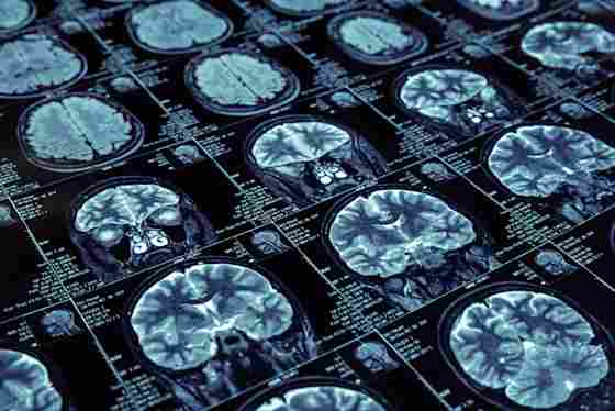 A group of MRI brain scans.