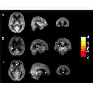 Reasoning Training in Veteran and Civilian Traumatic Brain Injury with Persistent Mild Impairment (Fig. 3)