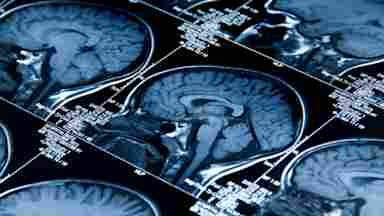 Pattern of Brain Scans