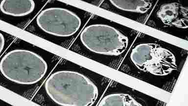 MRI images of the brain