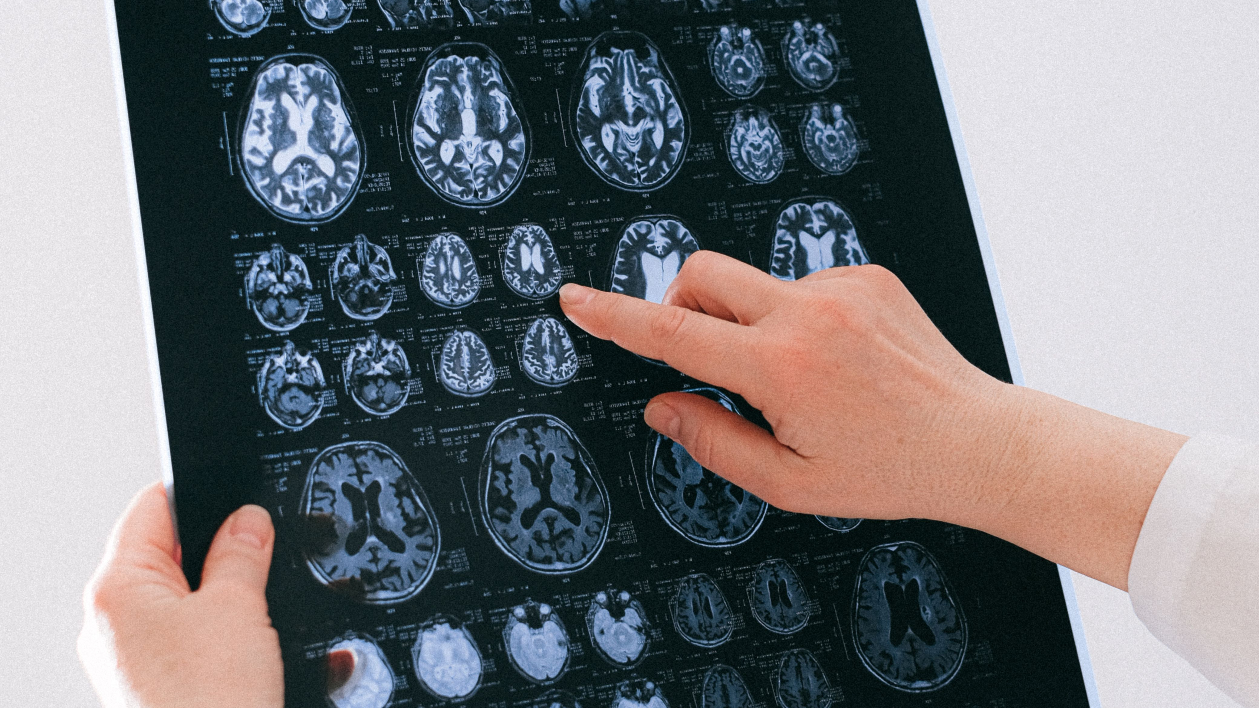 A person's hands holding and pointing at a brain MRI scan film showing multiple cross-sectional images of the brain.