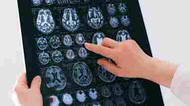 A person's hands holding and pointing at a brain MRI scan film showing multiple cross-sectional images of the brain.